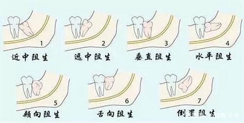 發(fā)炎的智齒什么時(shí)候拔才好？有些情況不能拔