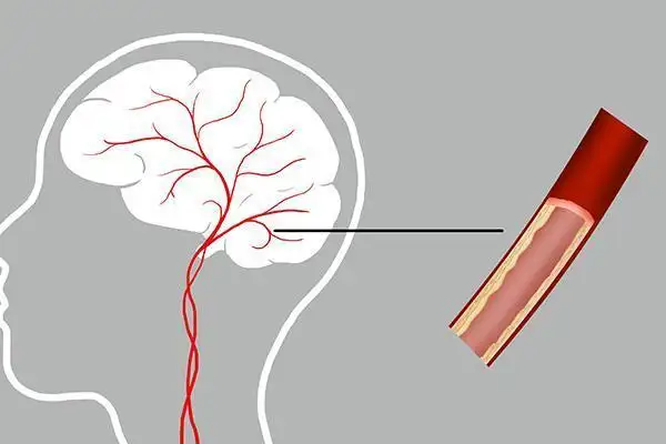 提醒中老年人：腦供血不足時(shí)，身體會(huì)發(fā)出4個(gè)信號(hào)！該如何治療？