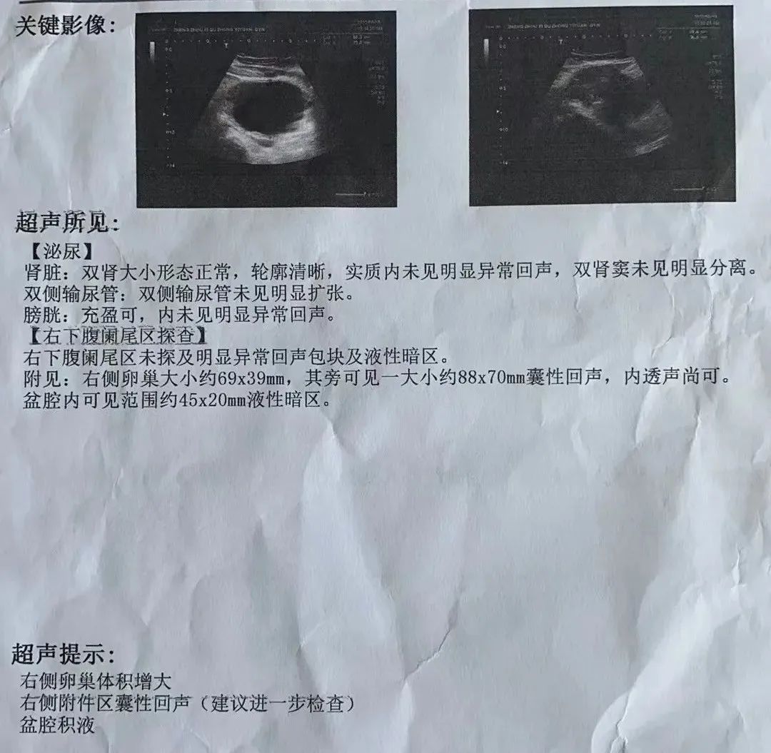 11歲女孩急性腹痛！竟然是卵巢囊腫蒂扭轉(zhuǎn)了