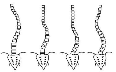 脊柱側(cè)彎如何康復(fù)？河南省中醫(yī)院西區(qū)醫(yī)院專家這樣說(shuō)