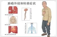 腿疼被診斷為肺癌晚期？腿上出現這4種現象，千萬要注意！